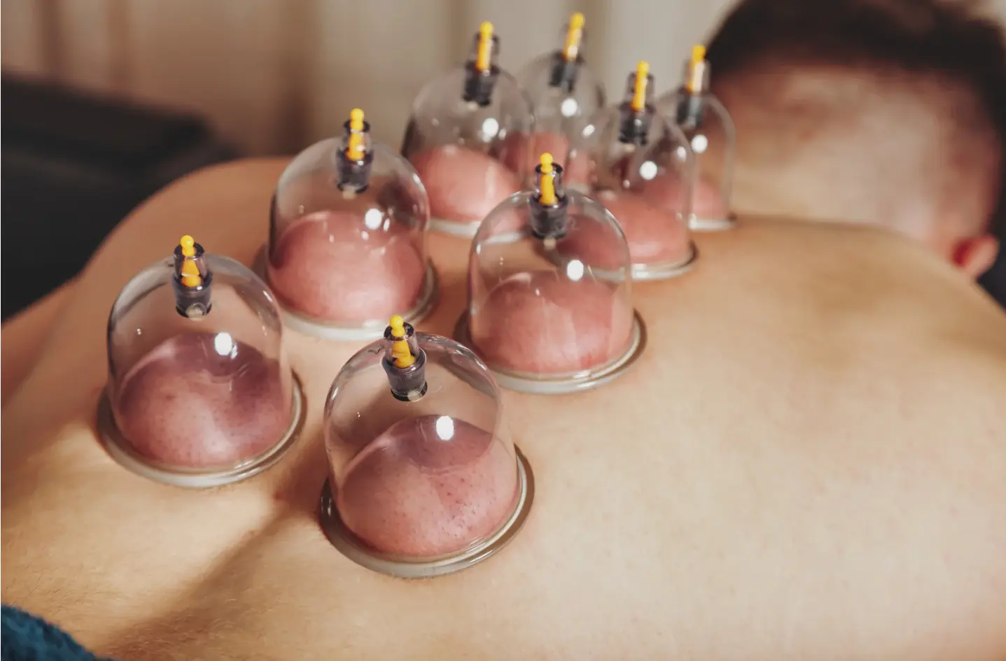 Cupping therapy cups applied along a client's back during a massage session at Balance Bodyworks & Wellness in Homewood, AL